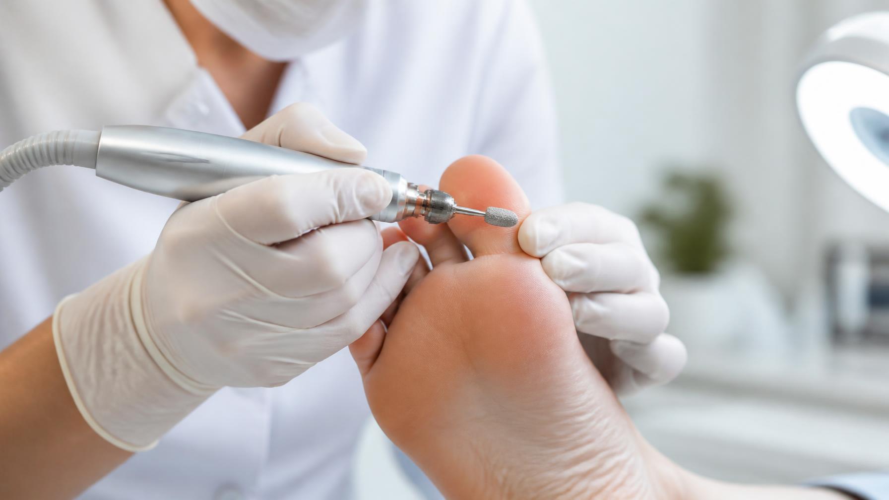 Uso de brocas profissionais em procedimento de podologia